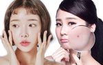 Ở nhà mà mụn cũng nổi chi chít, đó là bởi những thói quen tai hại bạn vẫn làm