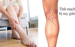 Bệnh nhân suy giãn tĩnh mạch mạn tính cần lưu ý gì trong mùa dịch Covid-19?