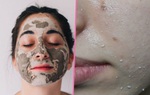 Chăm sóc da dầu mùa hè bạn nhất định phải biết 5 bí quyết này để mụn không bùng phát