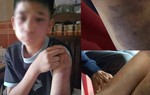 Bố đẻ và mẹ kế đánh cháu bé bầm tím khắp người