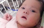 Xót xa bé gái bị bệnh tim, teo não không có tiền phẫu thuật