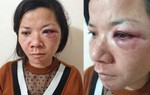 Xử phạt hành chính người chồng đánh vợ dã man tối mùng 2 Tết