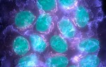 Xác định được các gene đột biến gây bệnh ung thư vú