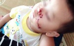 Bố say rượu, con 2 tuổi bị dao cứa rách mặt
