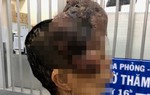 ‘Gỡ’ khối u sợi thần kinh vùng mặt 1,7kg cho bệnh nhân nữ