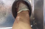 Nữ bệnh nhân nhập viện cấp cứu với bàn tay bị kẹt trong máy xay thịt