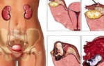Cảnh báo những biến chứng nguy hiểm khi mang thai ngoài tử cung