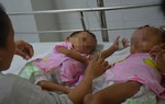  Mổ tách thành công 2 bé gái dính nhau phức tạp
