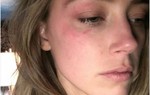 Amber Heard tố Johnny Depp bạo hành