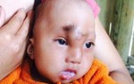 Bé gái người Dao có mũi bất thường chưa 1 lần được khám bệnh 