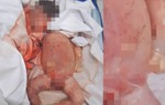 Vụ trẻ sơ sinh tử vong ở Hà Tĩnh: Bệnh viện xác nhận trẻ bị kéo đứt lìa cổ 