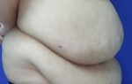 Thu gọn vòng 2 cho nữ doanh nhân nặng 79kg bị chảy sệ vùng bụng 