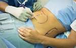 Bóc mỡ bụng trong mổ sinh, không tốt như nhiều người lầm tưởng
