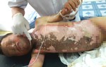 Trèo lên cột điện bắn chim, bé 10 tuổi bị điện giật bỏng 40% cơ thể