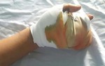 Nghịch pháo tự chế theo công thức trên mạng, 2 bé trai bị dập nát bàn tay