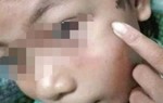 Nghi án bé gái thiểu năng bị công an viên đánh bầm tím vì trộm 50.000 đồng