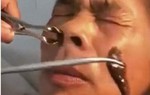 Bác sĩ kinh hãi khi gắp được con đỉa to tướng từ mũi bệnh nhân