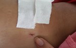 Bệnh viện Chợ Rẫy (TP.HCM): Đình chỉ hai nhân viên khoan nhầm cẳng chân bệnh nhân