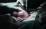 Nữ bệnh nhân bị bướu giáp 15 năm không điều trị phải 'cõng' khối u khổng lồ