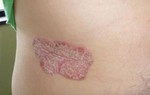 Kiểm soát bệnh vẩy nến thể mảng mạn tính hiệu quả
