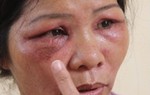 Sơ cứu khi bị kiến ba khoang đốt 