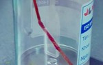 Bệnh nhi bị tăm tre đâm thủng ruột non mà tưởng đau dạ dày