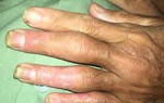 Coi chừng tàn phế khi bị viêm khớp vẩy nến