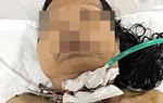Bị dao đâm xuyên cổ vì tai nạn hy hữu khi làm thịt gà