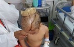 Bé gái bị chó hoang cắn rách đầu, hỏng mắt mong được giúp đỡ