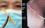 Bệnh nhân bị hóc xương cá gây áp xe trung thất nguy hiểm