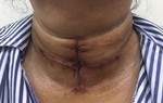 15 năm không điều trị bướu giáp, người phụ nữ phải cắt toàn bộ tuyến giáp