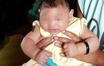 Việt Nam ghi nhận em bé đầu tiên mắc chứng đầu nhỏ do virus Zika