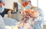 Bộ Y tế yêu cầu dùng phương pháp gây mê nội khí quản khi mổ lấy thai
