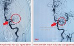 Kịp thời cứu sống bệnh nhân bị tắc động mạch não