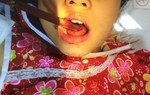 Bé gái 9 tuổi bị đũa đâm xuyên lưỡi