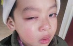 Lạng Sơn: Học sinh có nguy cơ hỏng mắt, nghi do bị cô giáo dùng thước đánh