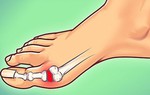 7 lời khuyên của bác sĩ giúp giảm nỗi đau bệnh gout