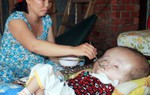 Bố tâm thần, con não úng thủy bẩm sinh