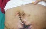 Hút mỡ bụng giảm béo: Đẹp đâu chưa thấy, chỉ thấy chằng chịt sẹo