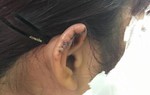 Nữ giáo viên khiêu vũ tố bị phụ huynh cắn đứt tai