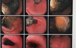 Mất mảng tóc, nghĩ con bị rụng tóc ngờ đâu bé nghiện ăn tóc