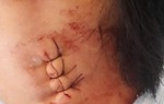 Vụ chẩn đoán viêm hạch, mổ không thấy hạch: Gia đình rút đơn khiếu nại