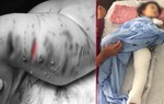 Hà Nội: Mẹ hãi hùng thấy con gái 2 tuổi bị chó Pitbull tấn công