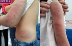 Bố say rượu đánh con gái 6 tuổi nhập viện