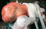 Bóc tách khối u quái khổng lồ bằng nửa trọng lượng trẻ sơ sinh
