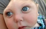 Phát hiện trẻ sơ sinh VN bị chứng đầu nhỏ nghi do Zika