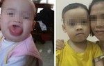  'Đánh tan' lưỡi phì đại không cần phẫu thuật