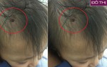 Qua nhà hàng xóm chơi, bé gái 19 tháng tuổi bị cắm đinh vít vào đầu