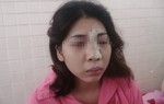 Mù mắt sau khi tiêm filler nâng mũi tại spa
