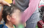 Gia đình bức xúc vì bé 5 tuổi bị bảo mẫu đánh sưng tím mặt do nôn ói